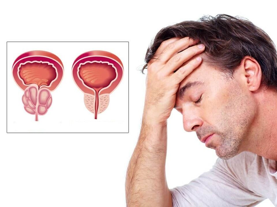 sintomas de prostatite em homens
