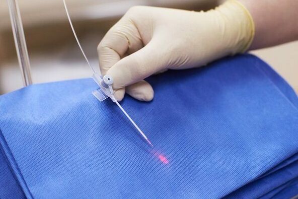 Em alguns casos, a terapia a laser é usada para prostatite crônica