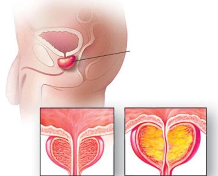 Localização da próstata, próstata normal e aumentada na prostatite crônica