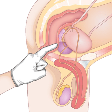 Determinação da condição da próstata por palpação para o diagnóstico de prostatite