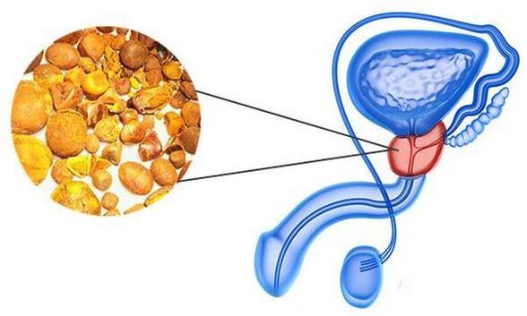 Problemas com prostatite
