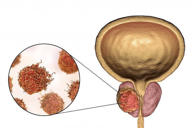 como é o dano à próstata