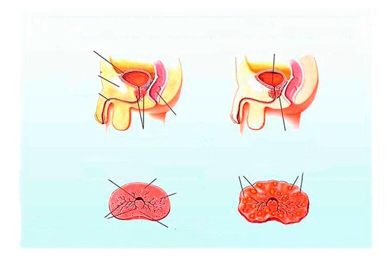 Sinais de prostatite crônica