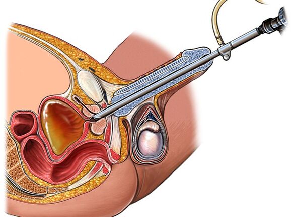 Tratamento da prostatite
