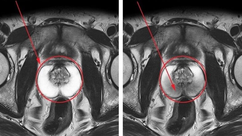 próstata saudável e inflamada com prostatite crônica
