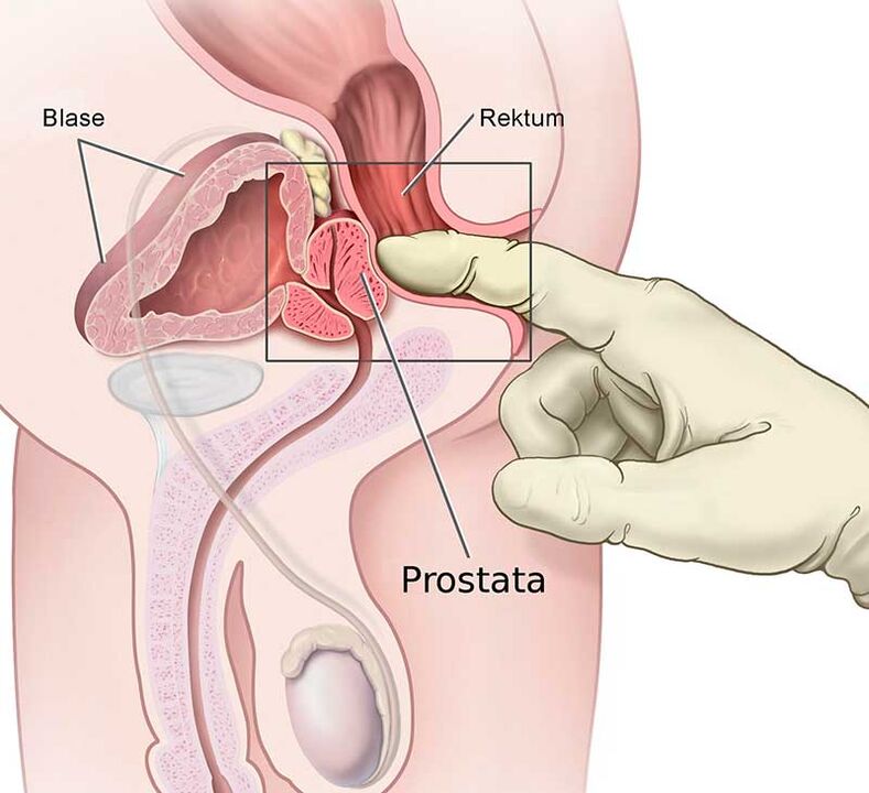 massagem de próstata para prostatite