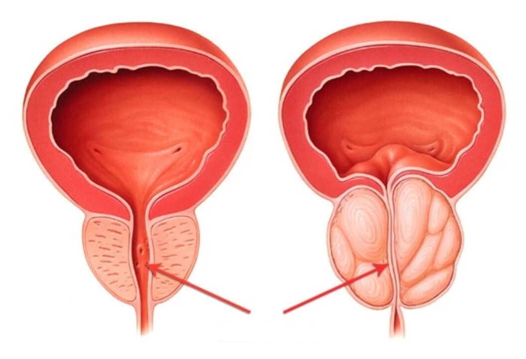 próstata saudável e inflamada com prostatite